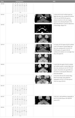 Case report: MRI changes of the inner ear in an MD patient with suspected immune dysfunction